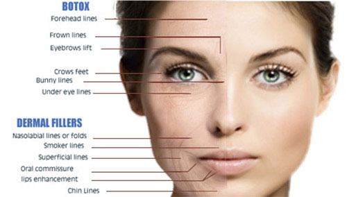 Dermal Fillers Beverly Hills CA